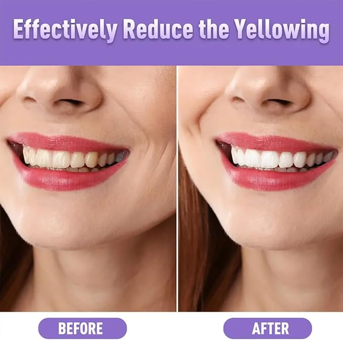 NomadNest Teeth Whitening Pen (4 Pcs) – Painless Teeth Whitener for Sensitive Teeth, Mint Flavor Whitening Gel, Removes Coffee & Tea Stains, Enamel-Safe, Travel-Friendly for a Brighter Smile