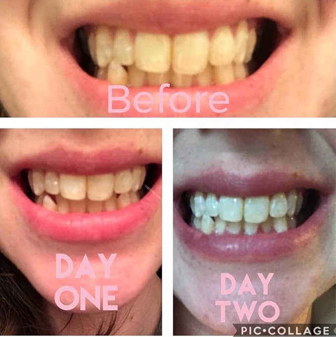 Teeth Whitening Kit with LED Light, 3 Carbamide Peroxide Teeth Whitening Gel Express Teeth Whitener. Remove Stains from Coffee, Smoking, Wine, Food (5 Piece Set)