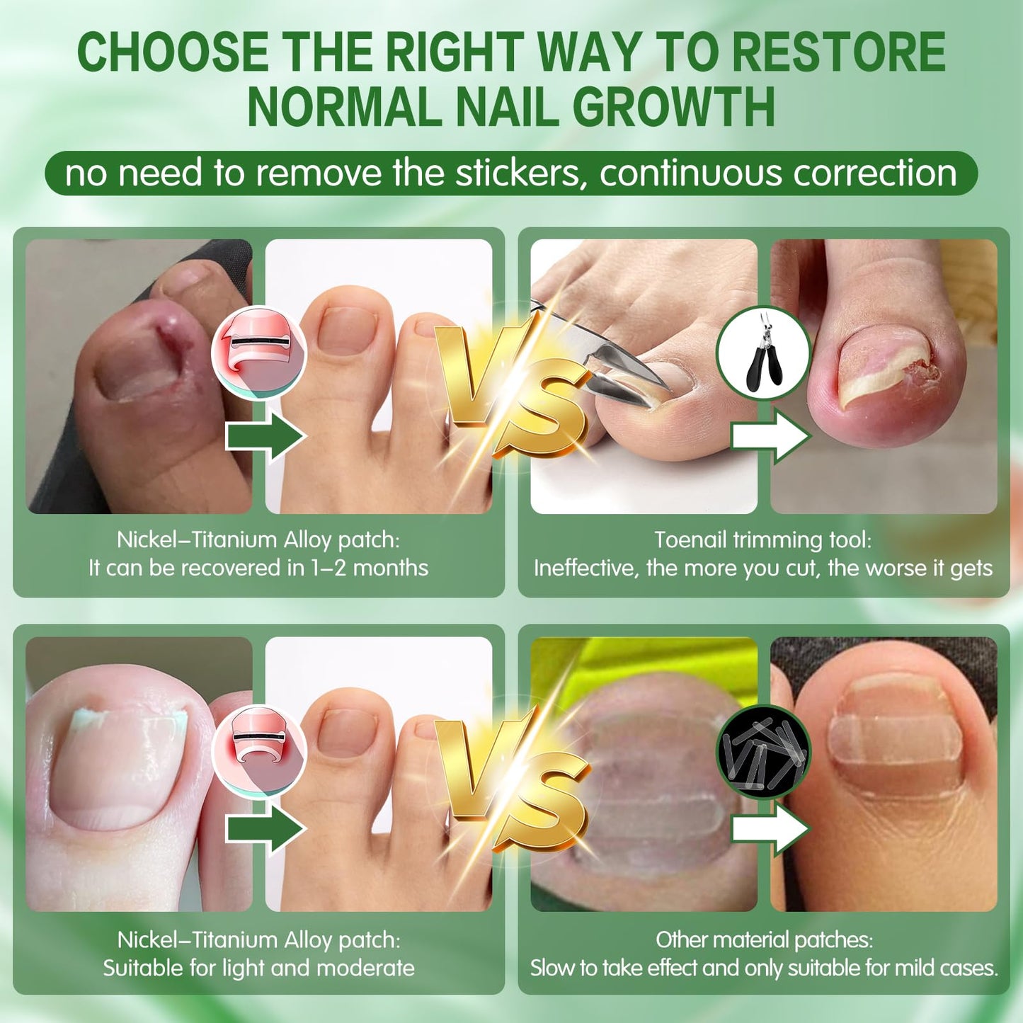 Titanium Alloy Ingrown Toenail Corrector, Professional Home Care In grown Removal Kit for Curved Repair and Ingrown Toenail Corrector,10Pcs Toe Nail Correction Strips,Stop Nail Biting Quick Relief