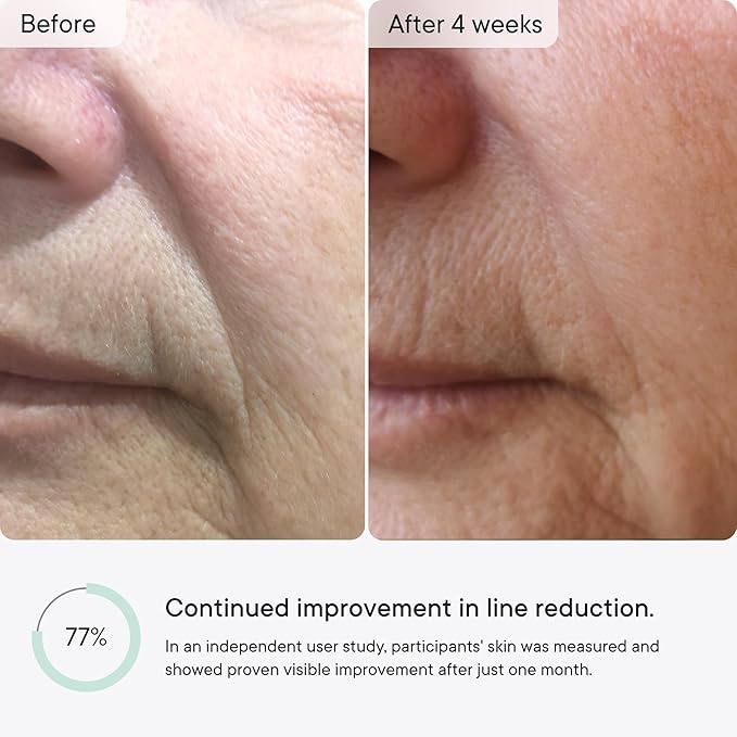 Qure Micro-Infusion Anti Wrinkle Patches for Smile Line, Frown lines, Under Eye Bags, Puffiness, Crow's Feet - Retinol, Caffeine, Peptides - Dissolvable for Overnight Use - 8 Pairs
