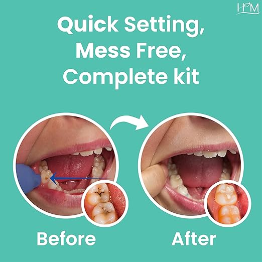 HM Zinc Oxide Eugenol Dental Cement Kit | Super Adhesive | Instant Tooth Repair, Cap, Crown & Bridge Filling | DIY, Self Curing, Sturdy & High Strength |Universal Shade| Emergency Dental Care | 1 Box