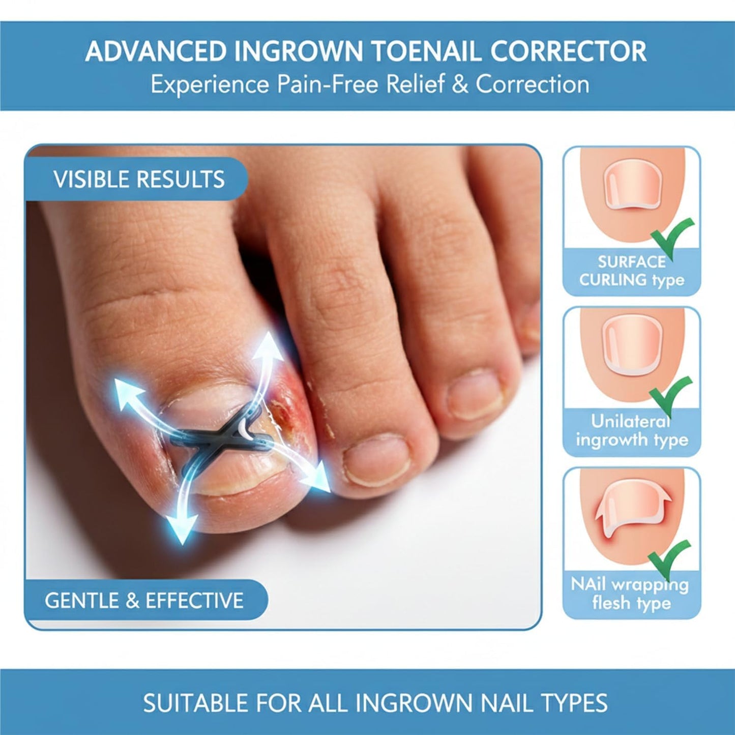 Titanium Alloy Ingrown Toenail Corrector 6PCS, Curved Nail Correction Tools Kit for Toenail Care