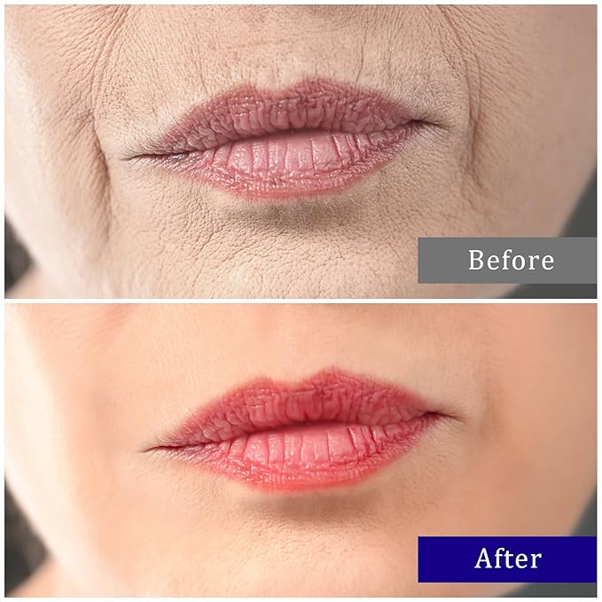 Anti Wrinkle Patches for Lip, Collagen Upper Lip Wrinkle Treatment, Smile Line patches Reduce Fine Lines & Wrinkles, 6 Pcs