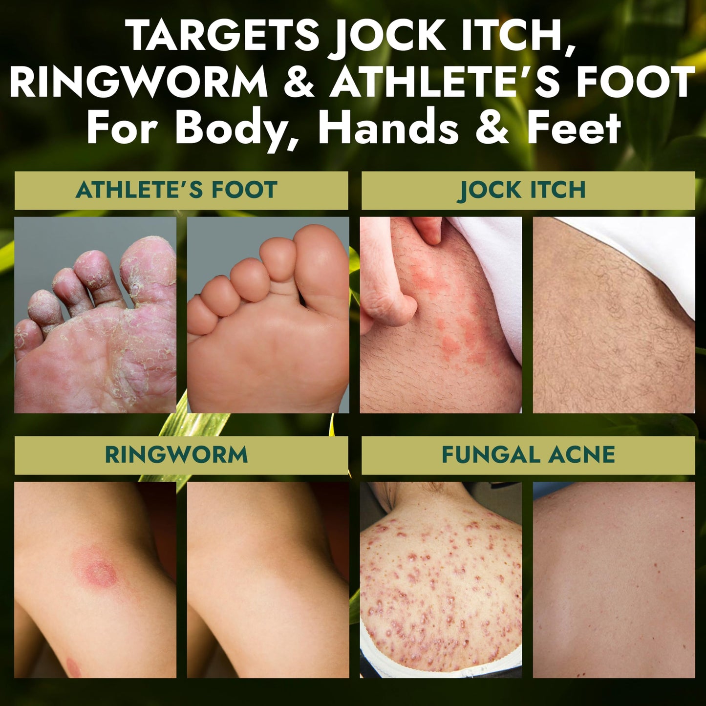 Antifungal Soap | Medicated Jock Itch Treatment, Fights Ringworm & Athlete's Foot | Soothing Tea Tree & Eucalyptus | 1% Tolnaftate for Effective Relief | Travel-Friendly with Soap Case