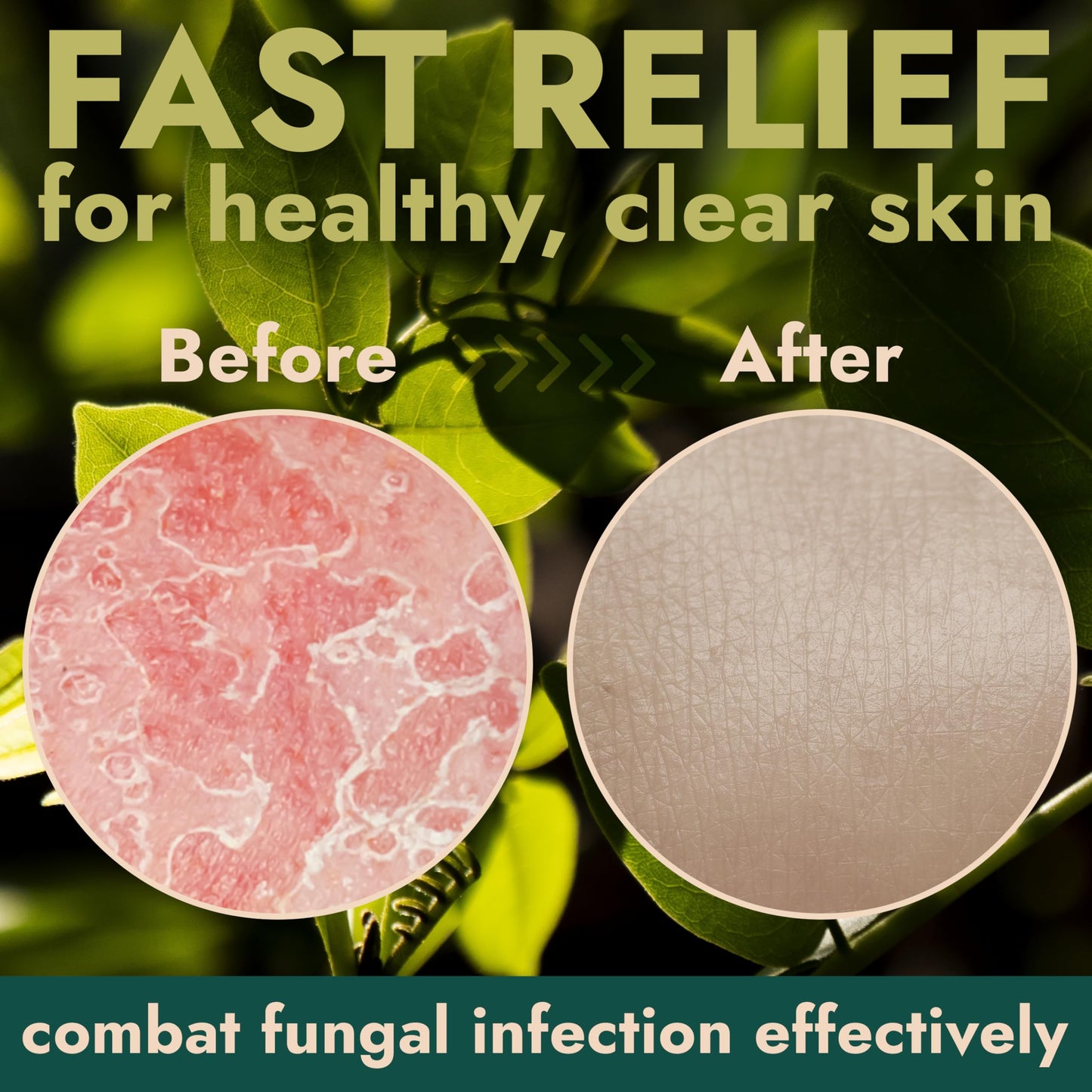 Antifungal Soap | Medicated Jock Itch Treatment, Fights Ringworm & Athlete's Foot | Soothing Tea Tree & Eucalyptus | 1% Tolnaftate for Effective Relief | Travel-Friendly with Soap Case