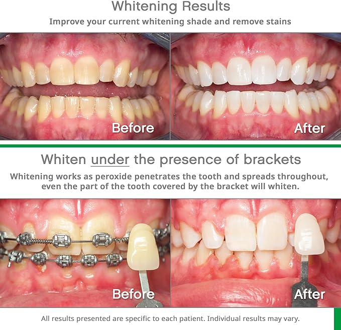 Opalescence Go 10% - Prefilled Teeth Whitening Trays Kit (10 Treatments) - 10% Hydrogen Peroxide - Mint Made by Ultradent Products. Go Teeth Whitening Kit -Mint- GO10-5193-1