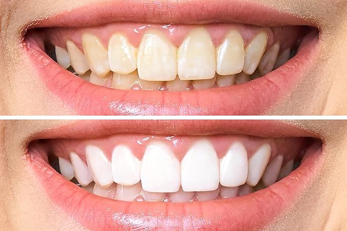 Dr. George's Dental Whitening Gel with Instructions