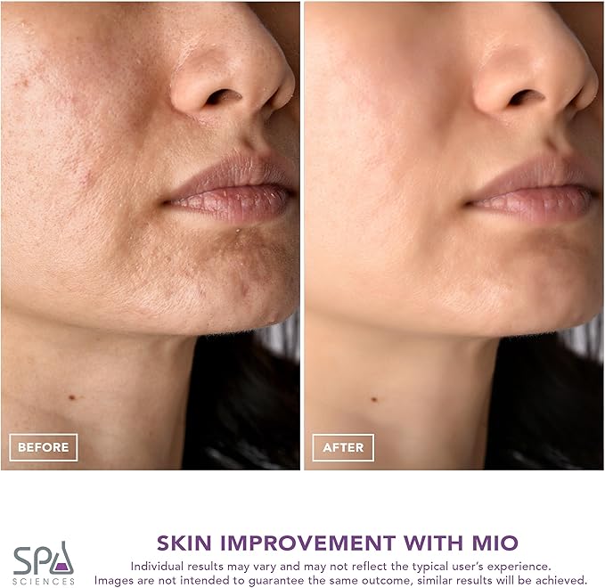 Spa Sciences - MIO - Diamond Tip Microdermabrasion Blackhead Remover, Pore Cleansing, & Resurfacing System - Reduces Acne Scars, Wrinkles, and Exfoliates for Clearer Skin